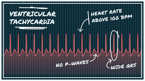 Polymorphic Ventricular Tachycardia Vs Ventricular Fibrillation