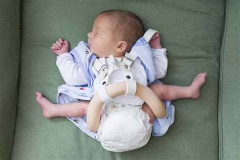 Causes And Treatment Of Orthopedic Problems In Newborns