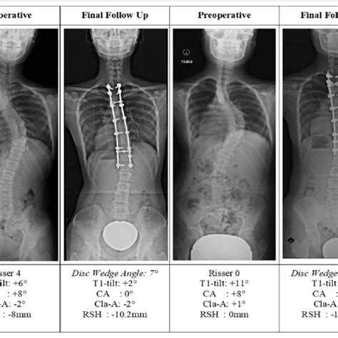 Correlation Between Scoliosis Research Society 22 And Absolute Value Of