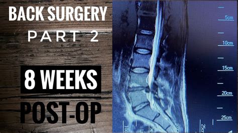 Back Surgery L4 L5 Laminectomy Recovery Part 2 Youtube