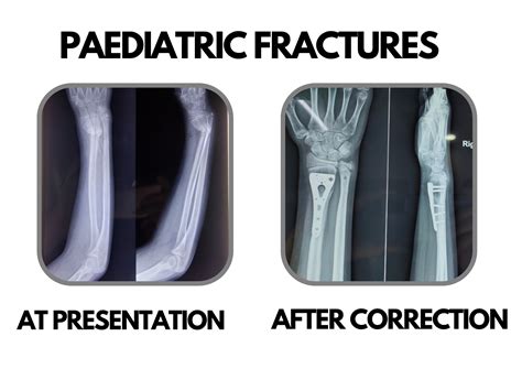 Paediatric Fractures Dr Deepak Khurana Paediatric Orthopaedic Surgeon