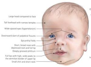 Noonan Syndrome Noonan Syndrome Awareness Association