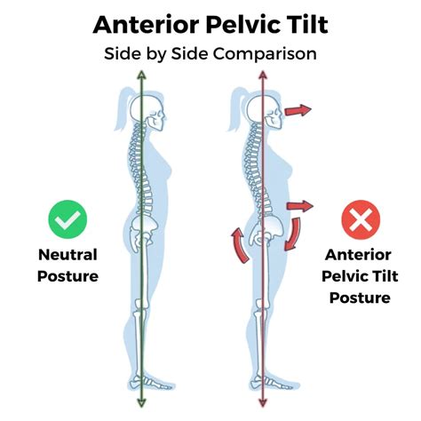 Stop Picking On The Anterior Pelvic Tilt Integrated Kinetic Neurology