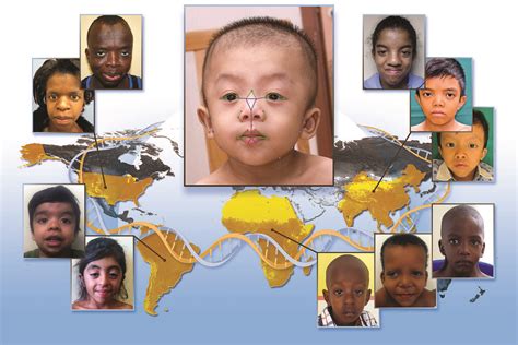 Noonan Syndrome A Variety Of Facial Features Illustrated Flickr