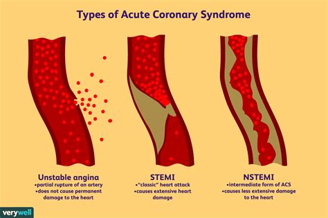 Nstemi Non St Segment Myocardial Infarction Explained