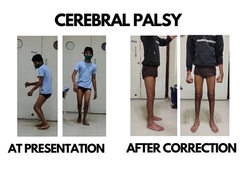 Cerebral Palsy Dr Deepak Khurana Paediatric Orthopaedic Surgeon