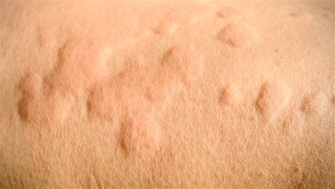 Raised Bumps On Skin