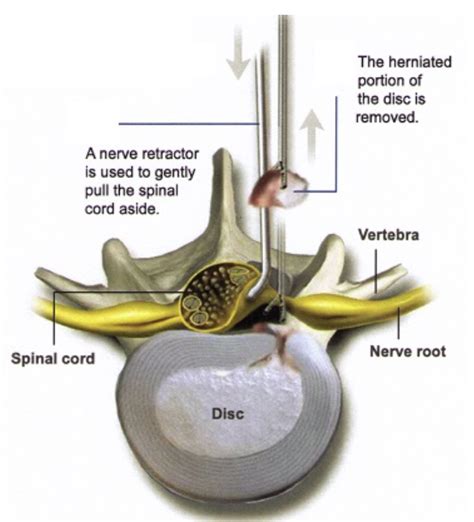 Lumbar Laminectomy Dr Paul Jeffords Md