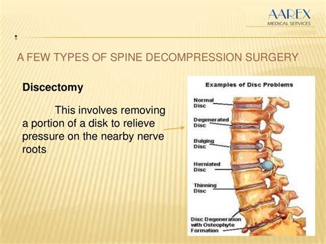 Spine Decompression Surgery