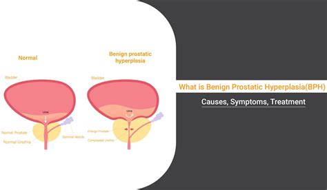 Benign Prostatic Hyperplasia BPH Causes Symptoms And Treatment