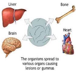 There are three stages of syphilis. Sign & Symptoms Of Syphilis That Can Be Easily Noticed ...