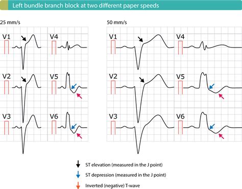 Stemi St Elevation Myocardial Infarction Diagnosis Criteria Ecg