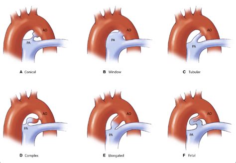 Variations In Patent Ductus Arteriosus Pda Configuration