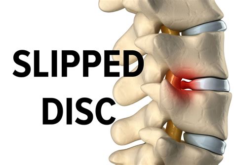 Slipped Herniated Disc Symptoms And Treatments RetraceHealth