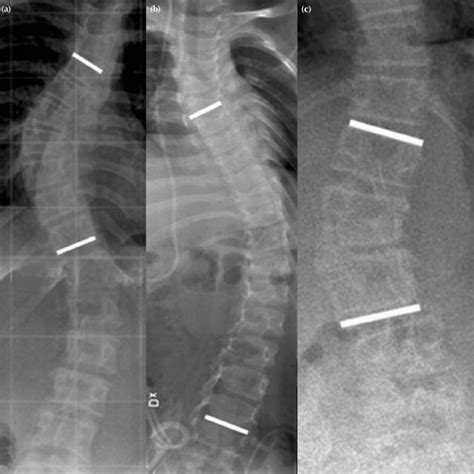 Figure Posteroanterior Radiographs Of 3 Different Types Of Scoliosis