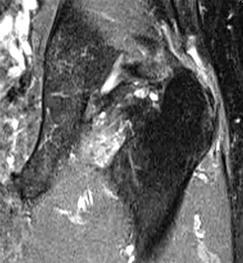 Lesion Of The Gluteus Medius Tendon Muscle Mri T2 Weighted Turbo Spin