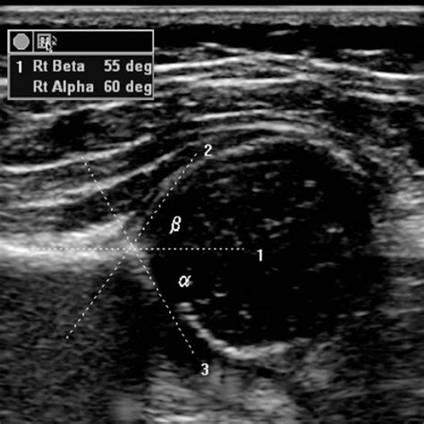 Normal Infant Hip Ultrasound Dont Forget The Bubbles