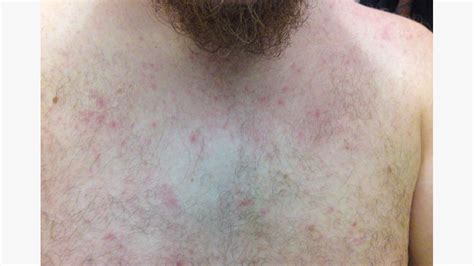 Rashes On Chest