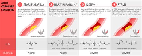 Acute Coronary Syndrome