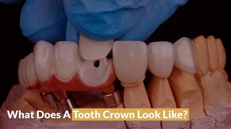 What Dental Crowns Look Like With Images Guide