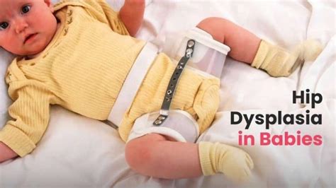 Understanding The Hip Dysplasia In Babies