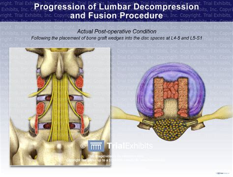 Progression Of Lumbar Decompression And Fusion Procedure Trialq