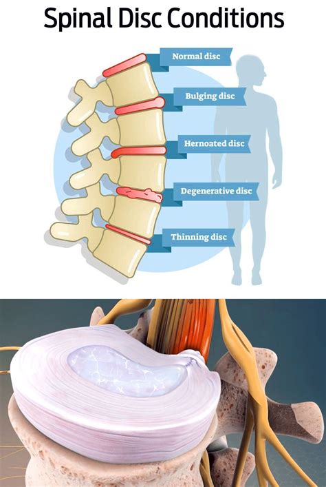 The Complete Guide To Bulging Disc Pain Symptoms El Paso S Personal