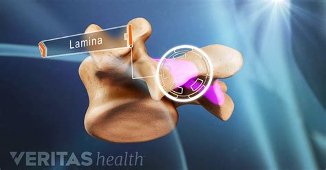 A Visual Guide To Lumbar Laminectomy Surgery