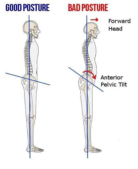 What Is Anterior Pelvic Tilt