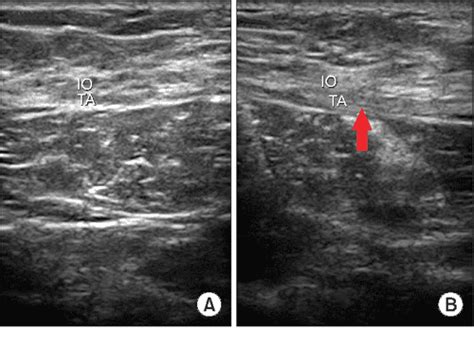 Pdf Diagnosis Of Ilioinguinal Nerve Injury Based On Electromyography