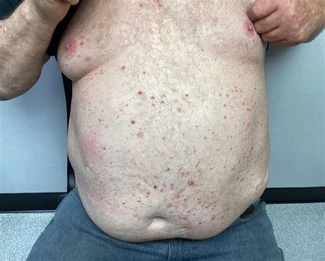 Clinical Challenge Red Itchy Rash On Chest Mpr