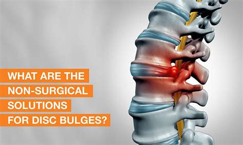 Disc Bulge Treatment Without Surgery QI Spine