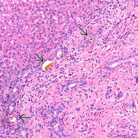 Biliary Atresia Histology