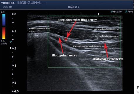 Ilioinguinal Genitofemoral Nerve