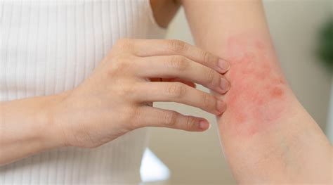 Types Of Rashes Do You Know About Any Of Them Healthkart