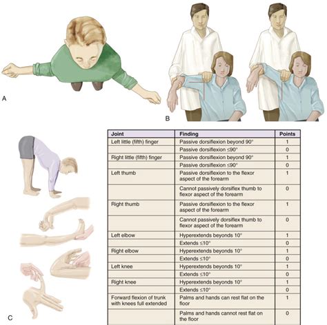 Anterior Shoulder Instability Musculoskeletal Key