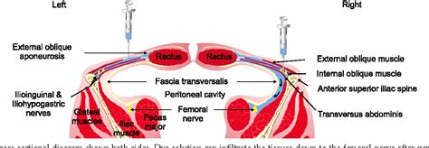 Figure 4 From Percutaneous Ilioinguinal Iliohypogastric Nerve Block Or