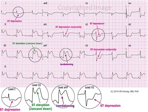 Stemi