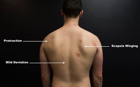 Winged Scapula And Shoulder Pain Case Study — Oni Wellington