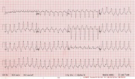 Vt Versus Svt • Litfl Medical Blog • Ecg Library Basics