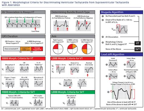 Ventricular Tachycardia Vs Supraventricular Tachycardia