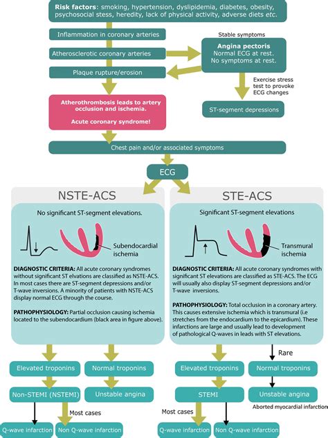 Stemi St Elevation Myocardial Infarction Diagnosis Criteria Ecg