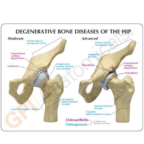 Hip Joint Anatomical Model 4 Stage Osteoarthritis Set