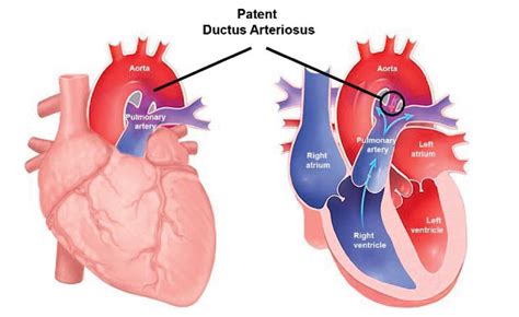 Patent Ductus Arteriosus Pathophysiology