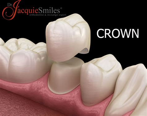 Benefits Of Dental Crownsdr Jacquie