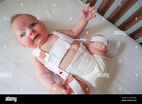 4 Month Old Baby With Hip Dysplasia Being Treated With A Pavlik Harness