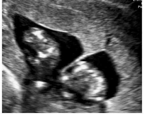 Instead they will just call them closures or anon functions or invent their own terminology. Ultrasound image of lambda sign in first trimester ...