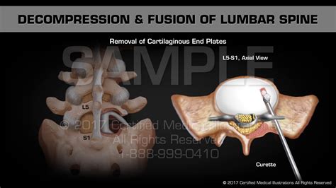 Lumbar Spinal Decompression And Fusion Surgery Mapageprek