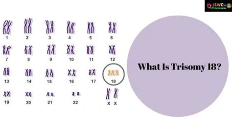 What Is Trisomy 18 Edwards Syndrome Types Of Trisomy 18