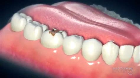 Dental Crowns Everything You Need To Know About Dental Crowns Youtube